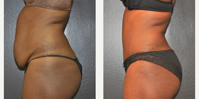 Case 2793 - 34 year old woman treated with Tummy Tuck