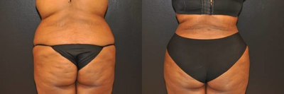 Case 2794 - 34 year old woman treated with Tummy Tuck