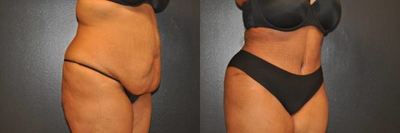 Case 2795 - 34 year old woman treated with Tummy Tuck