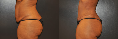 Case 2796 - 42 year old woman treated with Tummy Tuck