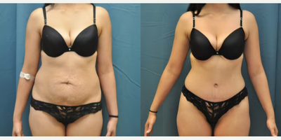 Case 28 - Woman treated with Tummy Tuck