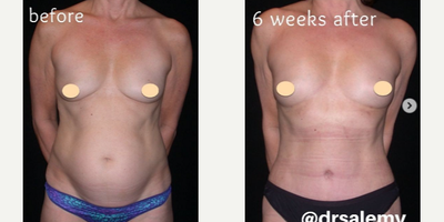 Case 280 - Woman treated with Tummy Tuck