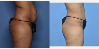 Case 2801 - 35-44 year old woman treated with Tummy Tuck