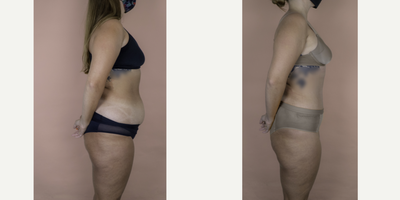 Case 2802 - 18-24 year old woman treated with Tummy Tuck