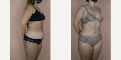 Case 2803 - 18-24 year old woman treated with Tummy Tuck