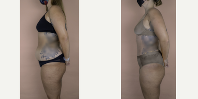 Case 2804 - 18-24 year old woman treated with Tummy Tuck