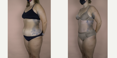 Case 2805 - 18-24 year old woman treated with Tummy Tuck