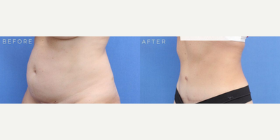 Case 2806 - Woman treated with Tummy Tuck