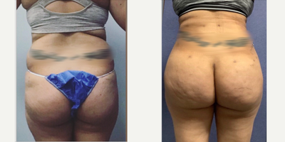 Case 2807 - 35-44 year old woman treated with Tummy Tuck