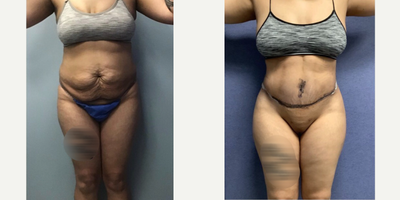 Case 2808 - 35-44 year old woman treated with Tummy Tuck