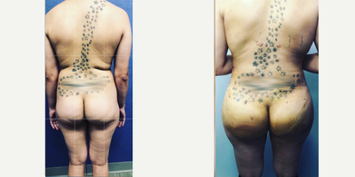 Case 2809 - 35-44 year old woman treated with Tummy Tuck