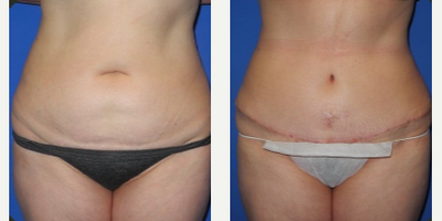 Case 281 - Woman treated with Tummy Tuck