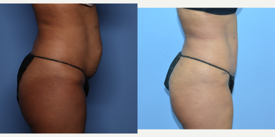 Case 2811 - 35-44 year old woman treated with Tummy Tuck