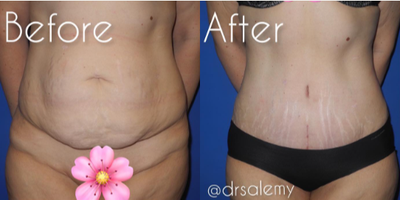 Case 282 - Woman treated with Tummy Tuck