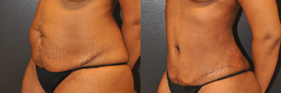 Case 2824 - 42 year old woman treated with Tummy Tuck