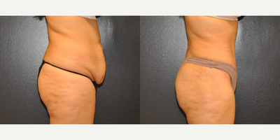 Case 2825 - 28 year old woman treated with Tummy Tuck
