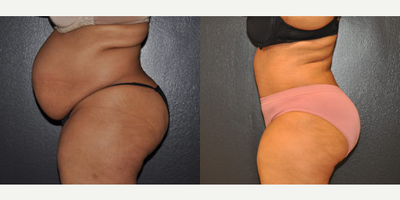 Case 2826 - 42 year old woman treated with Tummy Tuck