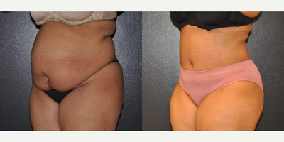 Case 2827 - 42 year old woman treated with Tummy Tuck