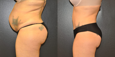 Case 2828 - 29 year old woman treated with Tummy Tuck