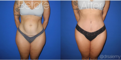 Case 283 - Woman treated with Tummy Tuck