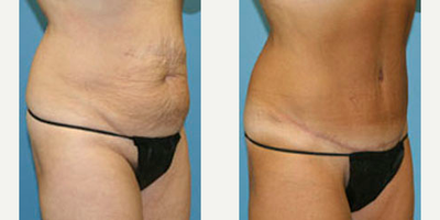 Case 2830 - Woman treated with Tummy Tuck