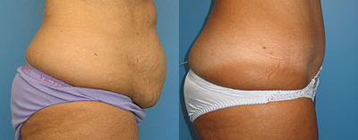 Case 2831 - Woman treated with Tummy Tuck