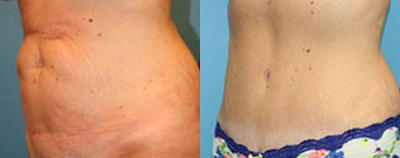 Case 2832 - Woman treated with Tummy Tuck