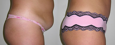 Case 2833 - Woman treated with Tummy Tuck