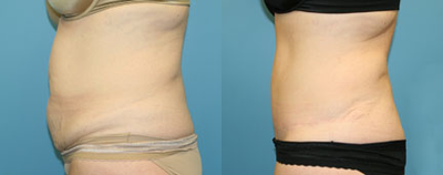 Case 2834 - Woman treated with Tummy Tuck