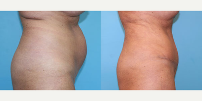 Case 2835 - Woman treated with Tummy Tuck