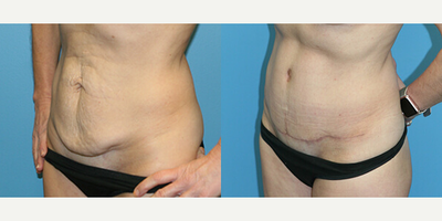 Case 2836 - Woman treated with Tummy Tuck