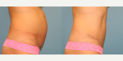 Case 2837 - Woman treated with Tummy Tuck