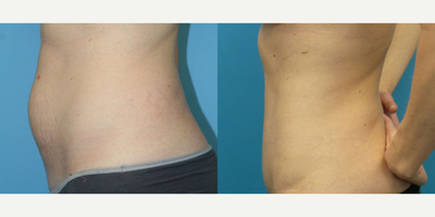 Case 2838 - Woman treated with Tummy Tuck