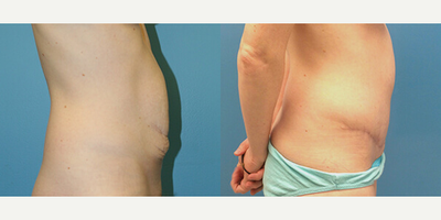 Case 2839 - Woman treated with Tummy Tuck