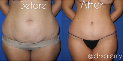 Case 284 - Woman treated with Tummy Tuck