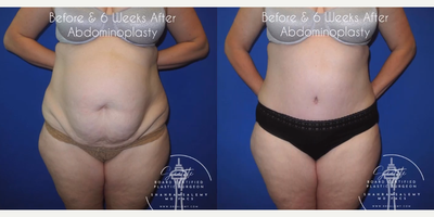 Case 285 - Woman treated with Tummy Tuck