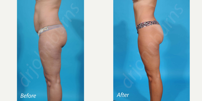 Case 2856 - 35-44 year old woman treated with Tummy Tuck