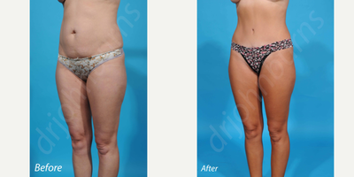 Case 2857 - 35-44 year old woman treated with Tummy Tuck