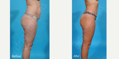 Case 2858 - 35-44 year old woman treated with Tummy Tuck