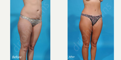 Case 2859 - 35-44 year old woman treated with Tummy Tuck
