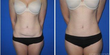 Case 286 - Woman treated with Tummy Tuck