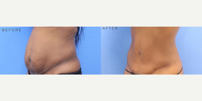 Case 2860 - Woman treated with Tummy Tuck