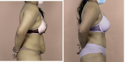 Case 2865 - 35-44 year old woman treated with Tummy Tuck