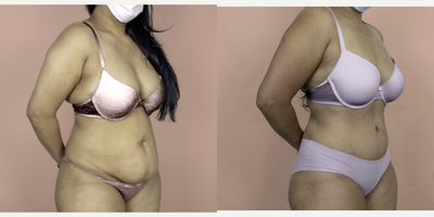 Case 2866 - 35-44 year old woman treated with Tummy Tuck