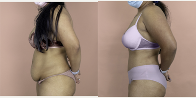 Case 2867 - 35-44 year old woman treated with Tummy Tuck