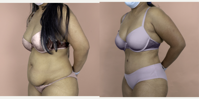 Case 2868 - 35-44 year old woman treated with Tummy Tuck