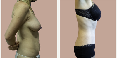 Case 2869 - 45-54 year old woman treated with Tummy Tuck