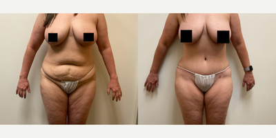 Case 287 - Woman treated with Tummy Tuck