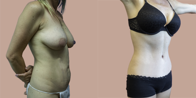Case 2870 - 45-54 year old woman treated with Tummy Tuck