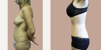 Case 2871 - 45-54 year old woman treated with Tummy Tuck